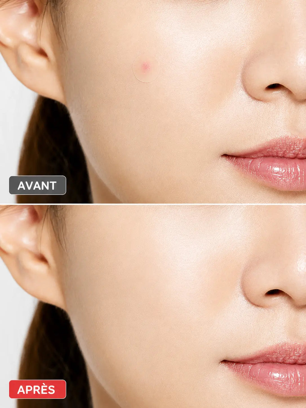 COSRX- Acne Pimple Master Patch