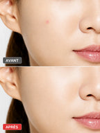 COSRX- Acne Pimple Master Patch